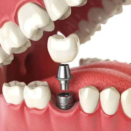 implant.jpg