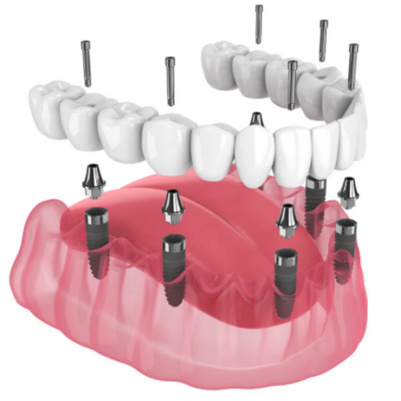 rehabilitation globale dentiste sore rehabilitation globale dentiste sore