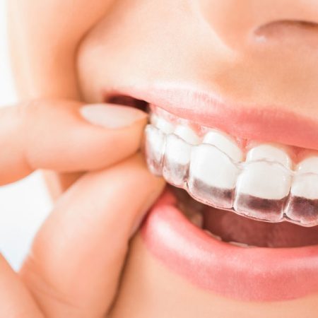 smile-with-invisalign